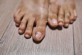 Close-up of female feet with a black toenail
