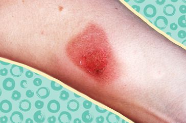 cellulitis