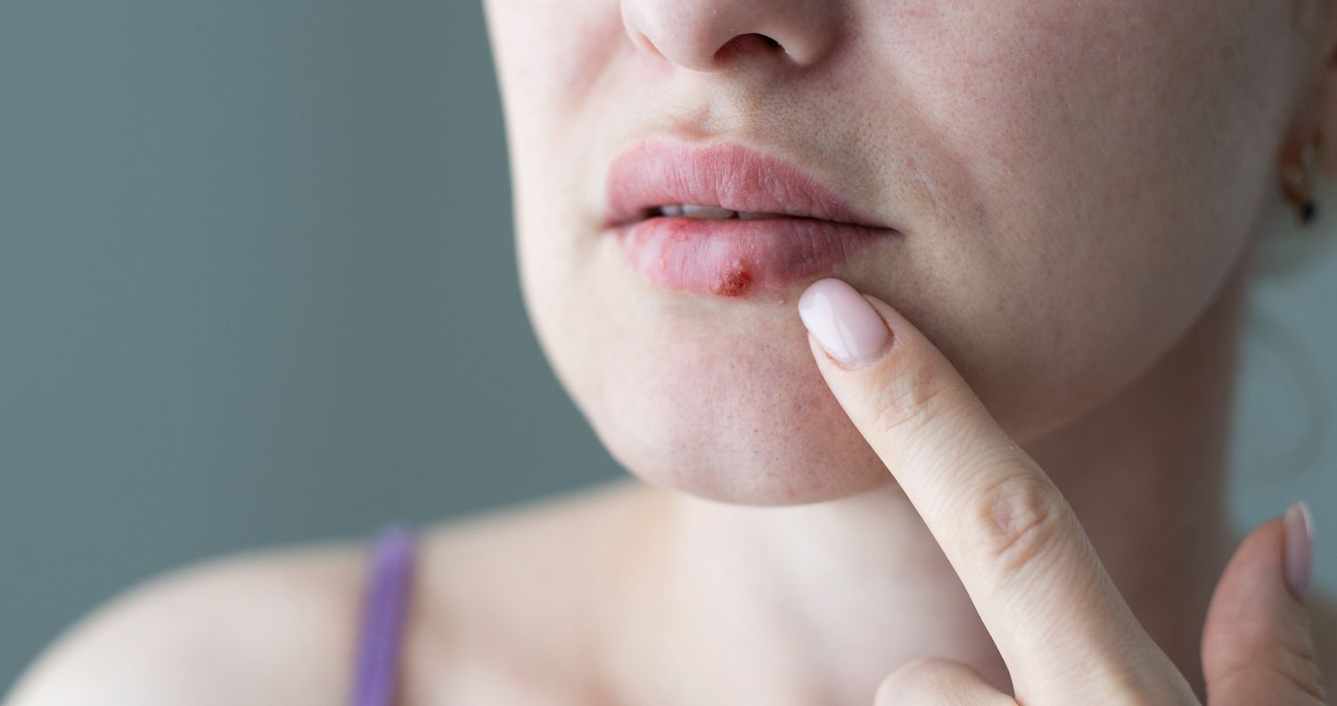 woman with cold sore on lip