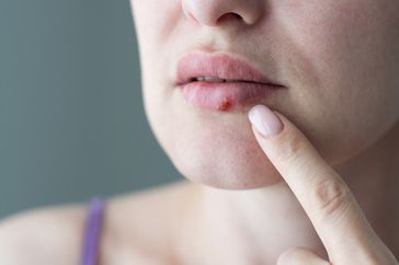 woman with cold sore on lip