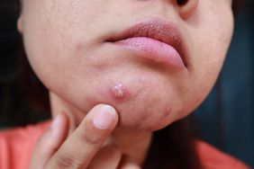 A woman with cystic acne on her chin