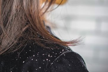 person with dandruff 