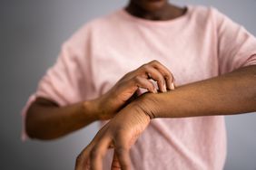 woman scratching her wrist