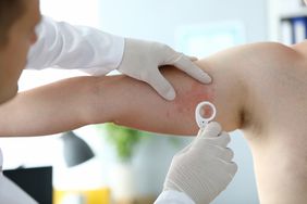 Doctor examines hives on a patient's arm.