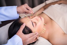 female getting acupuncture treatment on face