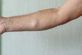 A man with lipomas - benign tumors on the body. multiple lipomas