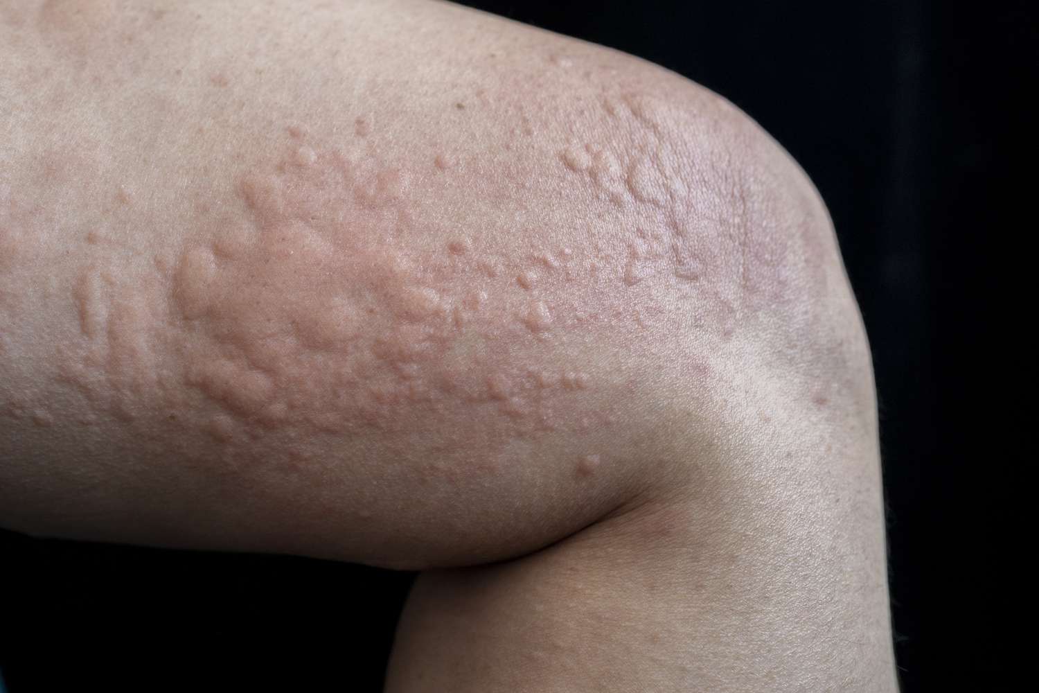 angiodemia on a leg due to hives urticaria