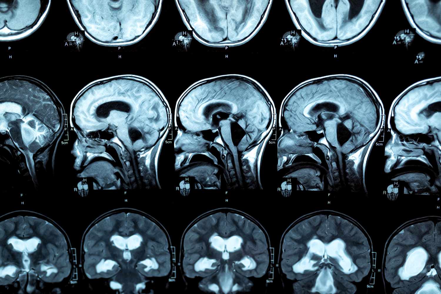 MRI scan or magnetic resonance image of the brain showed obstructive triventricular hydrocephalus with clinical of hydrocephalus: cognitive decline, incontinence. Neurology, medical service concept.