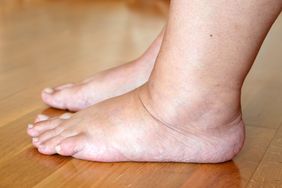 Swollen legs, or edema, of a person with cirrhosis