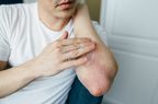 White male scratching rash on elbow