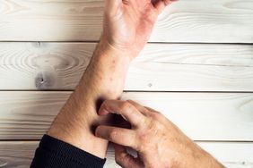 Top view of unrecognizable man suffering from psoriasis, scratching red, inflamed, flaky rash on skin of arm with fingers on white wooden background.