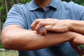 man scratching itchy yeast infection on skin
