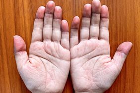 Cyanotic hands or peripheral cyanosis or blue hands at Southeast Asian, Chinese child with congenital heart disease.