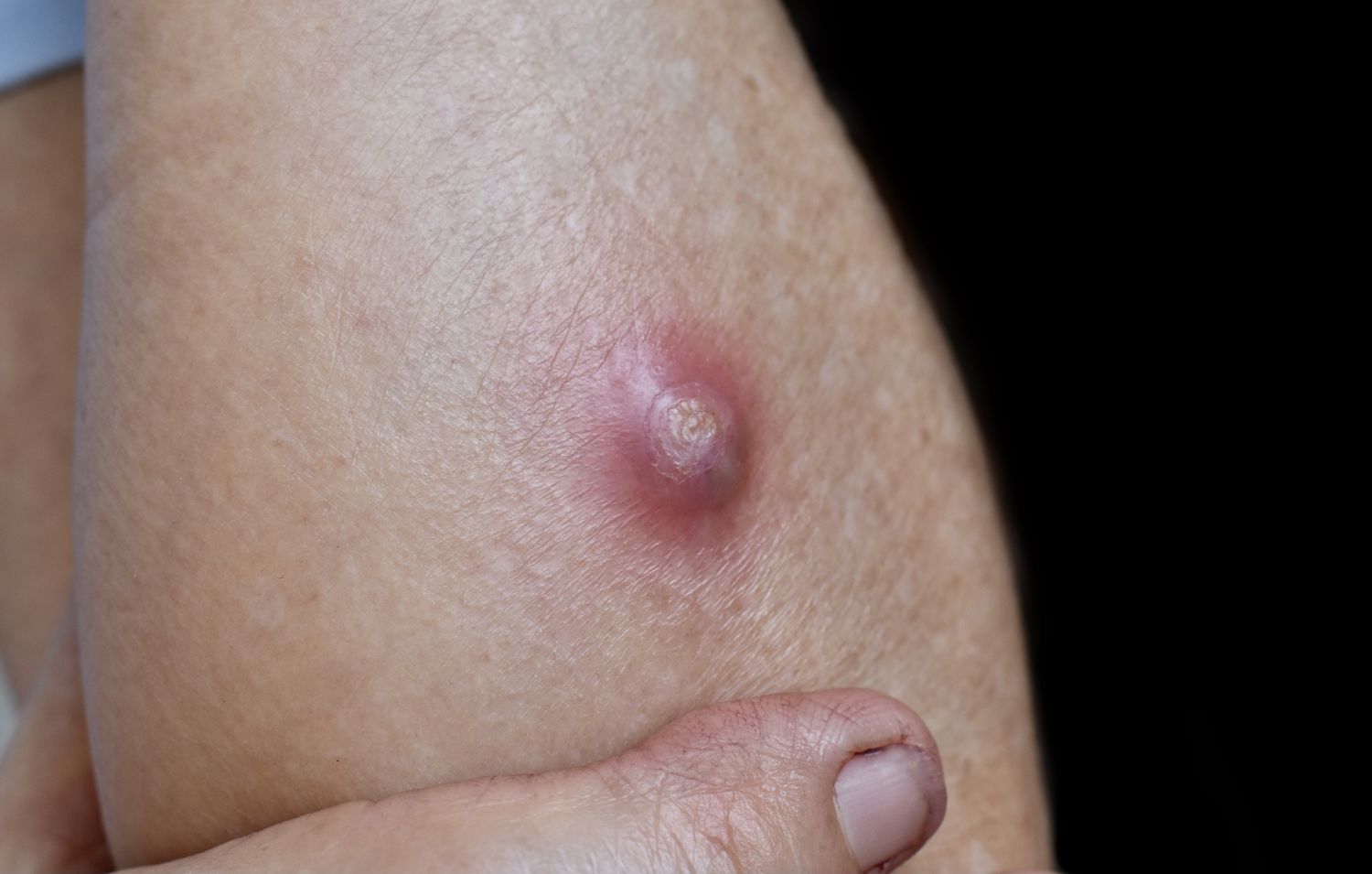 mssa infection on skin
