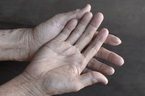 pale palmar surface of clammy, cold hands