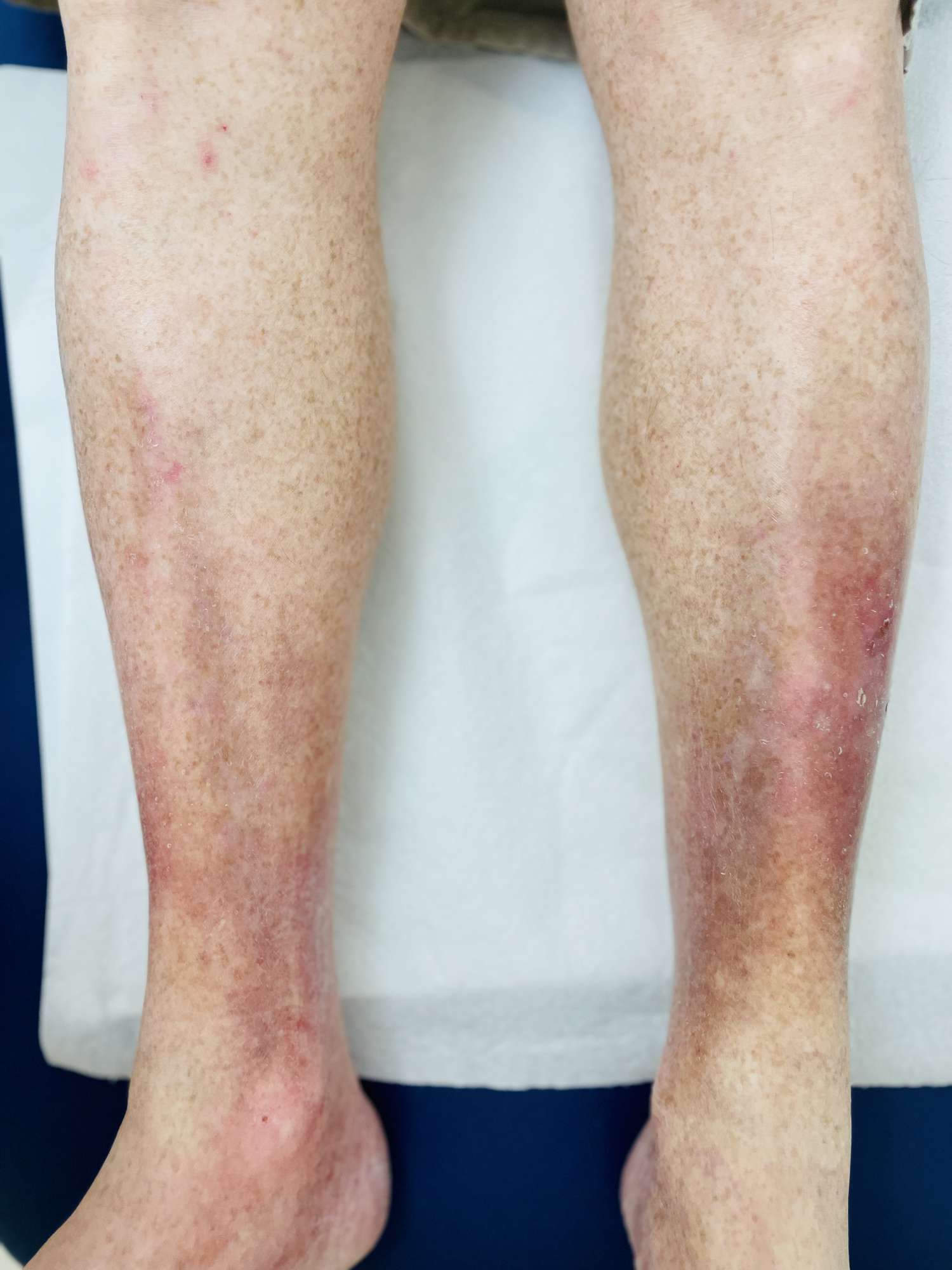 legs of a person with venous stasis, also called stasis dermatitis, gravitational dermatitis, and venous eczema