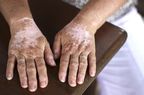 skin-condition-vitiligo