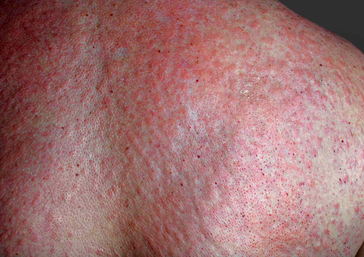 man with severe hives after being exposed to an irritant