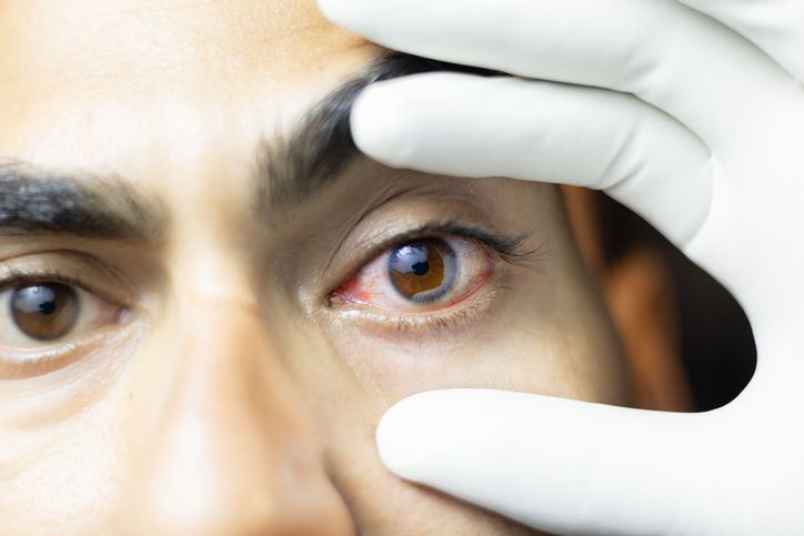 person with pink eye