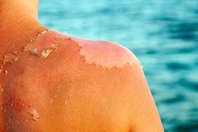 Skin peeling sunburn peel
