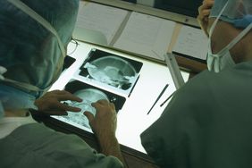 deep brain stimulation