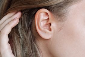 Close up of a woman's ear with blackheads and small pimple forming