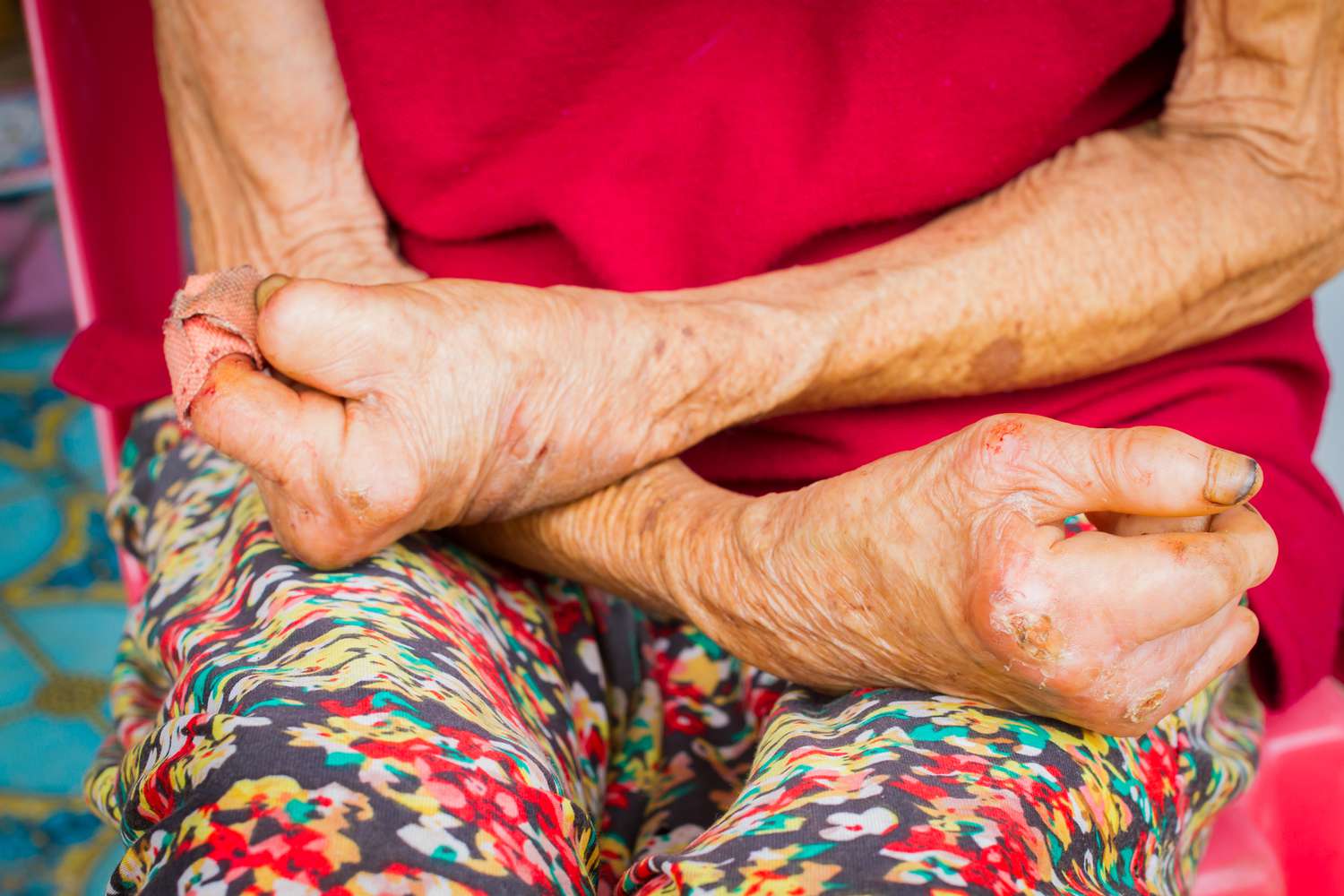 Closeup hands of old woman suffering from leprosy.