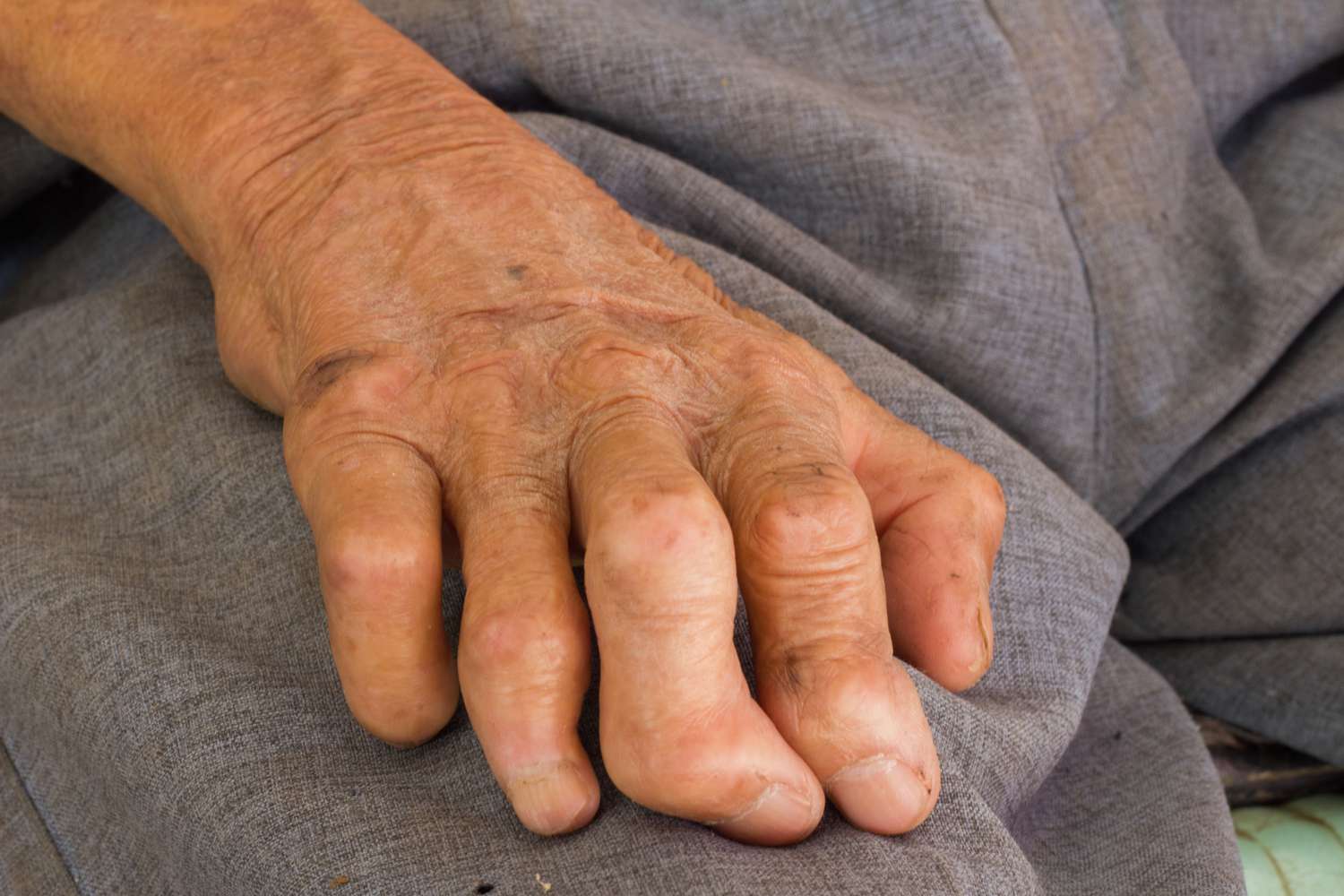 hand of a person with leprosy
