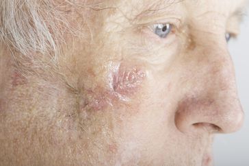Stitches in a mans face after having Mohs surgery to remove a melanoma. 