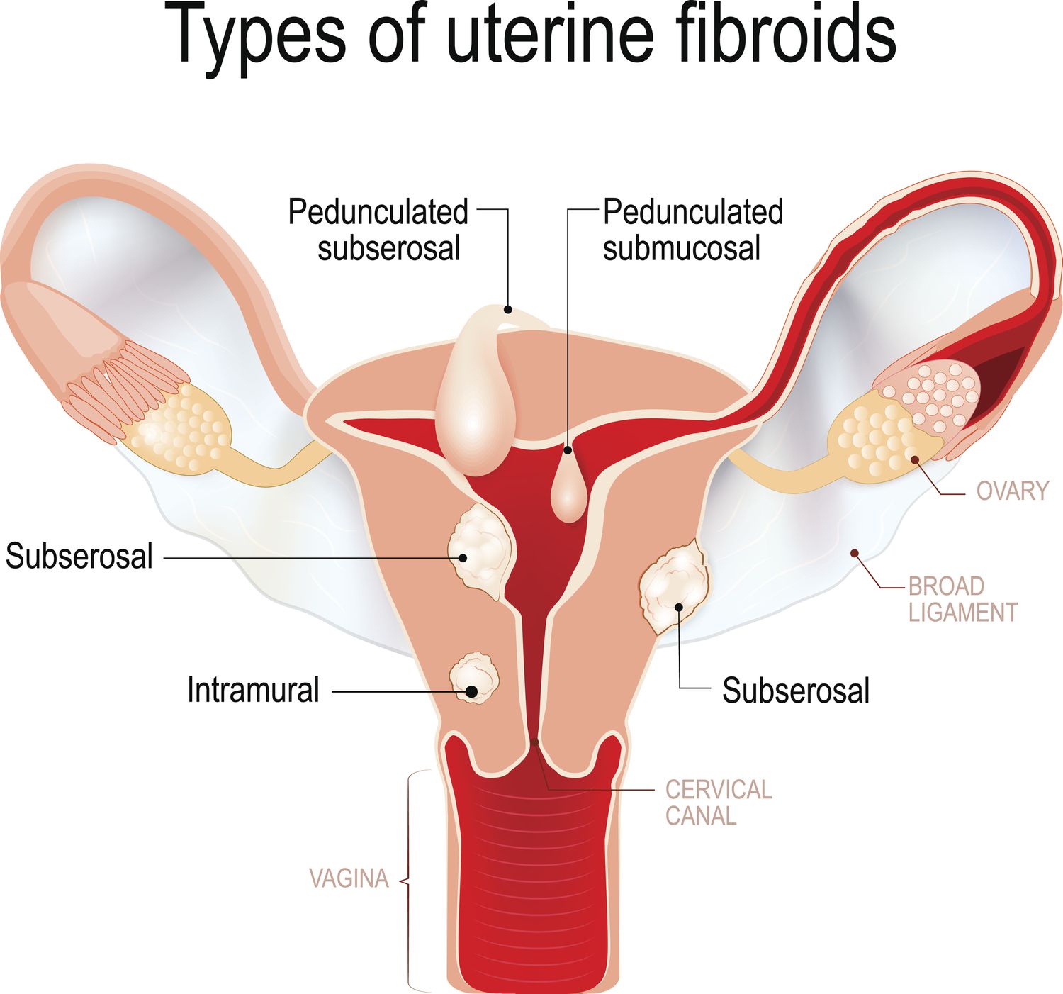 Schematic drawing of various types of uterine fibroids: subserosal, intramural, submucosal, and pedunculated fibroids. Female reproductive system (internal sex organs). uterus with broad ligament on the white background. Human anatomy