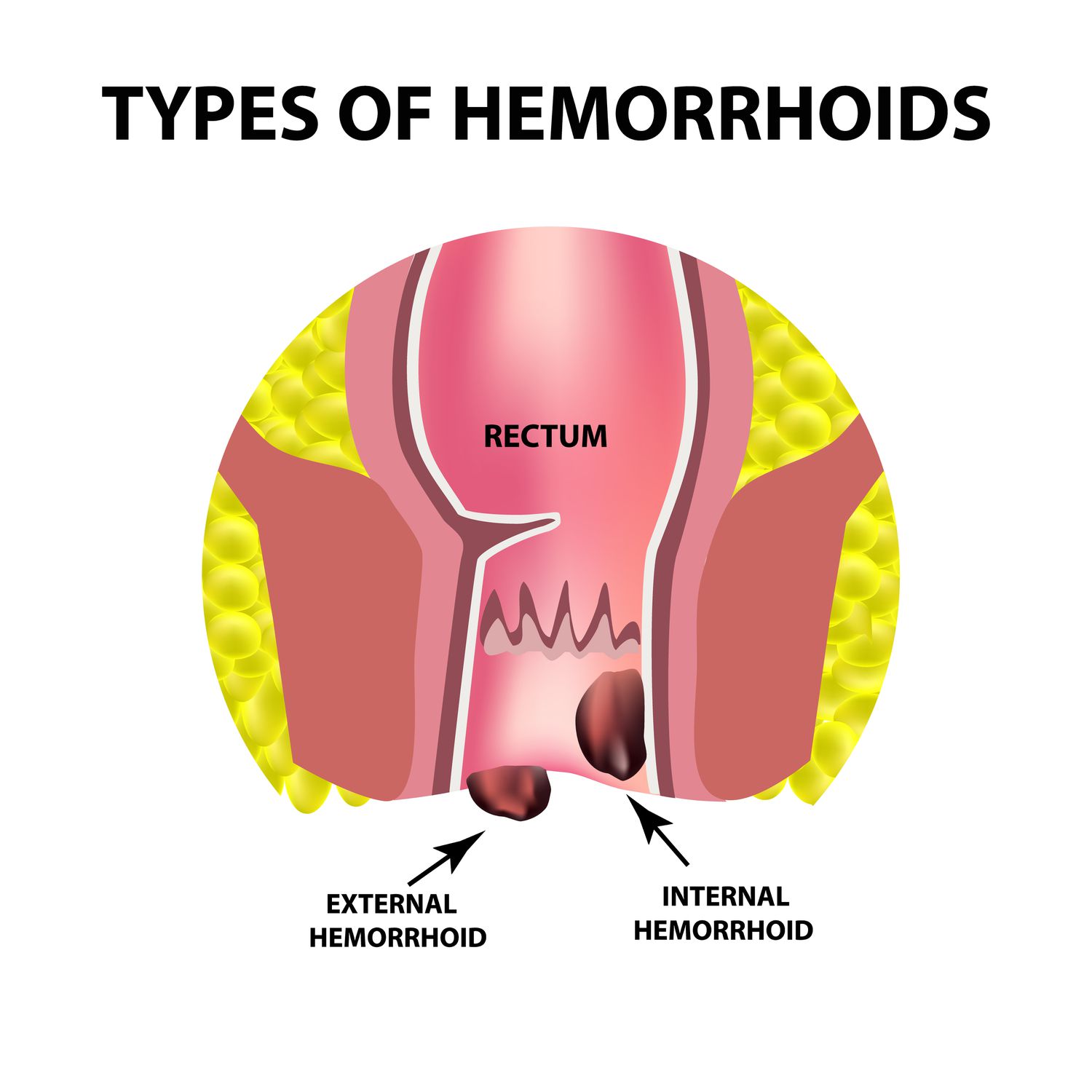 Two types of hemorrhoids are external and internal. Rectum structure. Intestines. colon. Internal and external hemorrhoidal node.