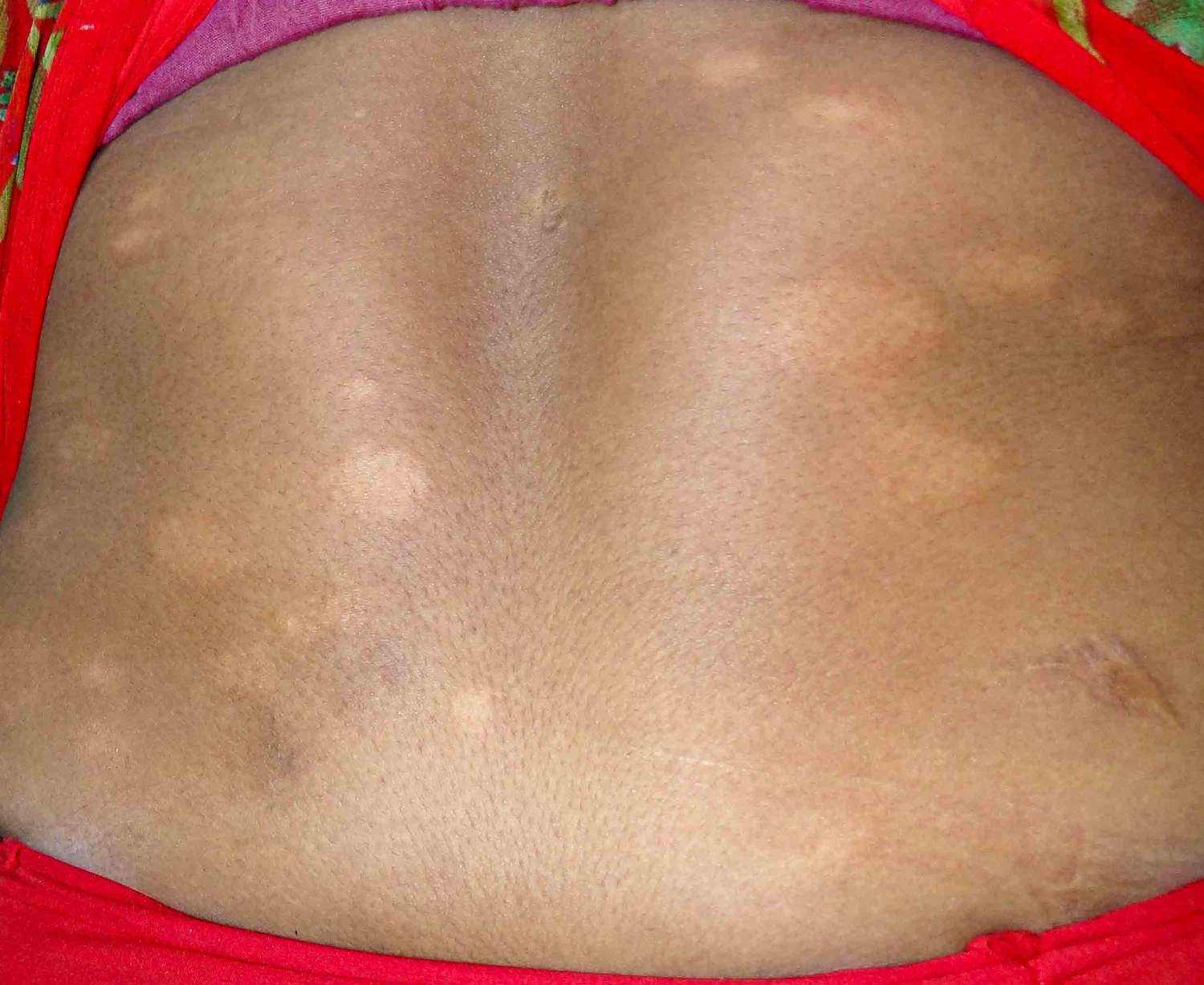 Clinical image of borderline lepromatous leprosy shows multiple erythematous infiltrated plaques over the back of a female with skin of colour. Note the imperfect asymmetry.