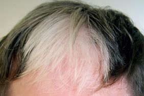 hair with poliosis