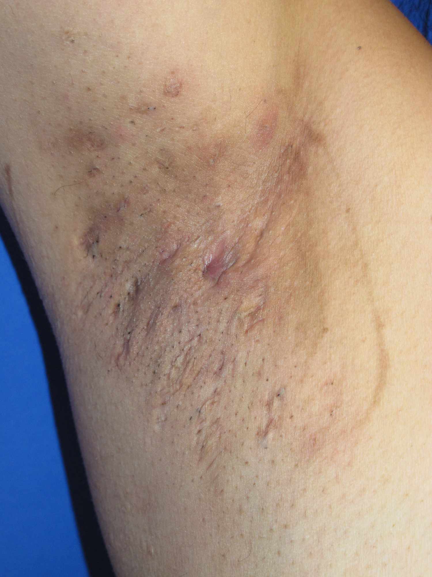 HS on armpit