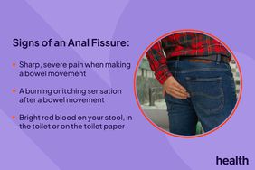 Signs of an Anal Fissure