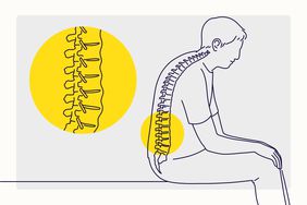 Overview Illustration of Ankylosing Spondylitis