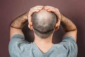 Rearview of a man holding his head that has a bald spot from alopecia