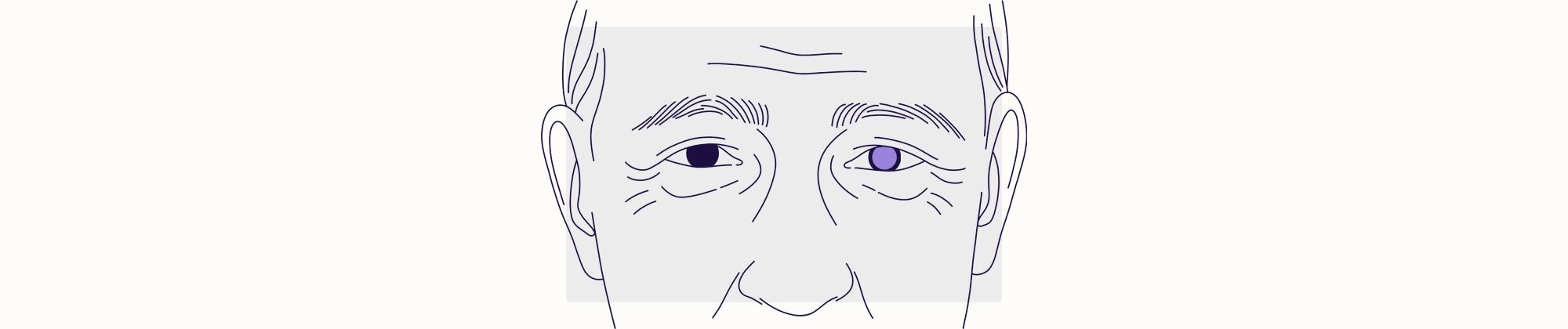 Health Overview Illustration - Cataracts