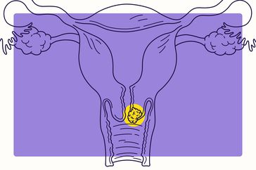 Overview Illustration - Cervical Cancer