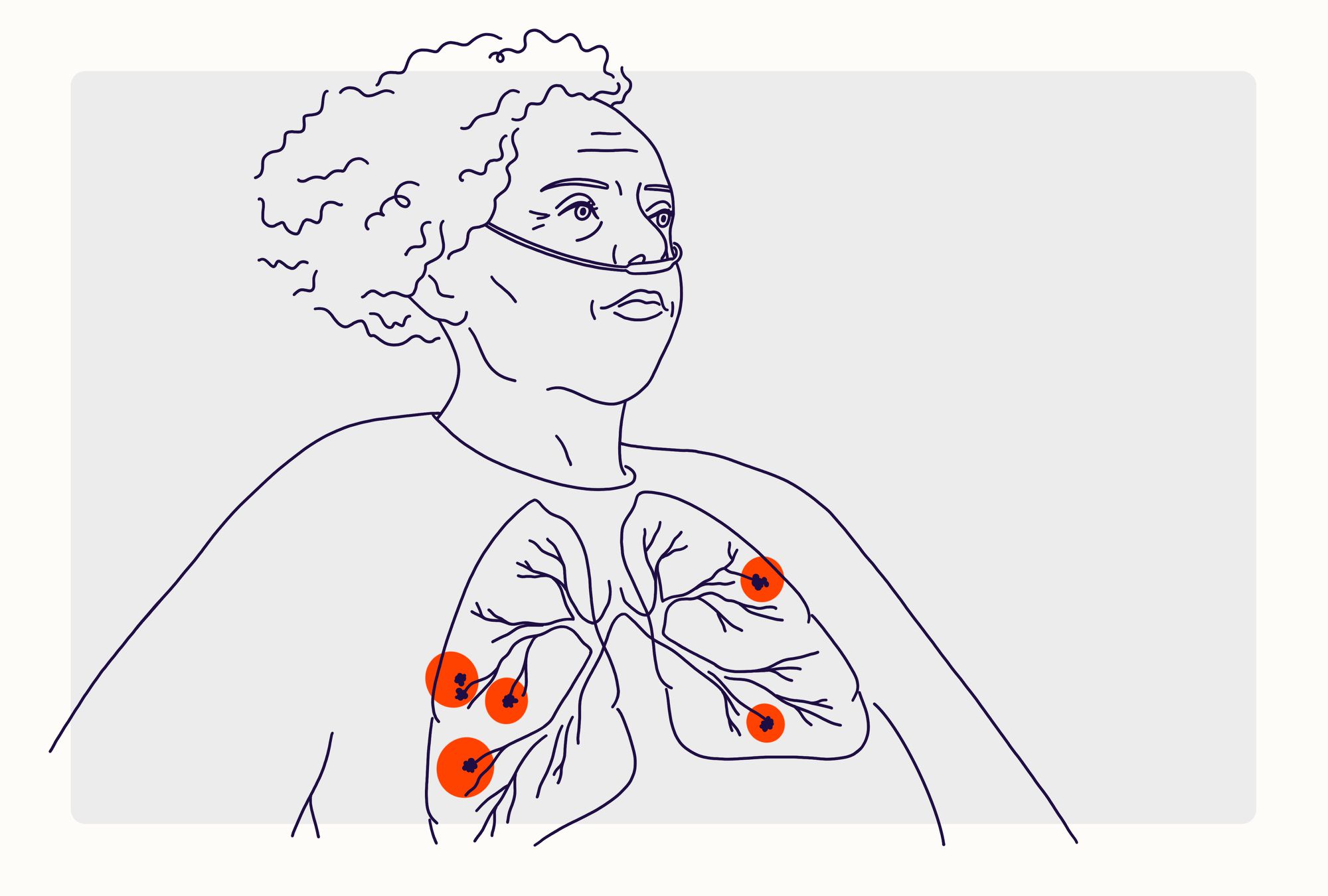 Overview Illustration - Emphysema