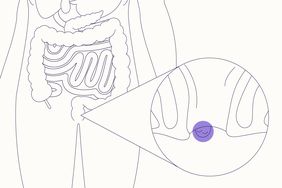 Illustration of external hemorroids
