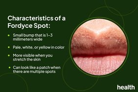 A close-up of Fordyce spots on a person's lips with a list of the spots' characteristics