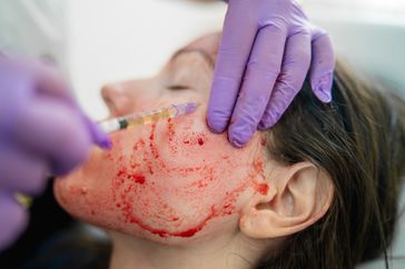 photos of blood plasma PRP treatment
