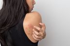 woman showing her skin itching behind , with allergy rash urticaria symptoms