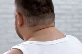 photo of person's rear view showing a buffalo hump on the back of the neck