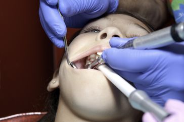 child at the dentist getting a pulpotomy, a root canal on a baby tooth