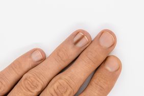 closeup photo of the hand, showing a dark brown line on the the nail of the left ring finger