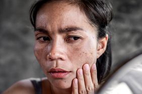 woman having skin problem checking her face with dark spot