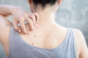 Back acne - person scratching at back acne
