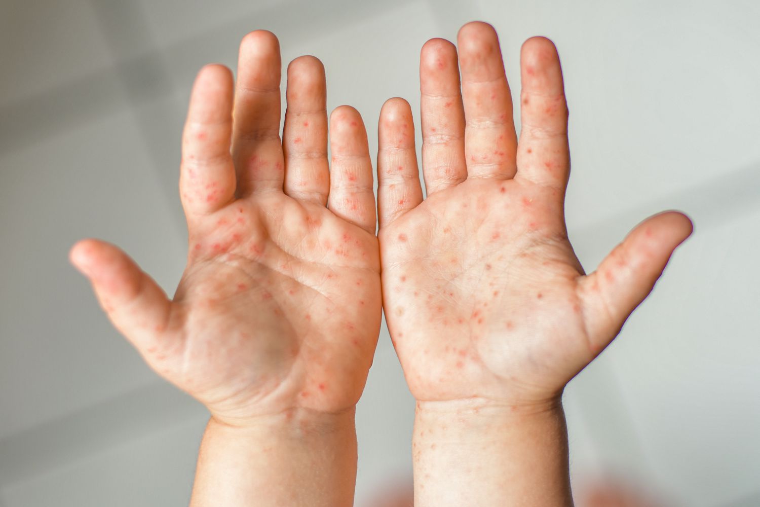 A child with a rash on the palm of their hands